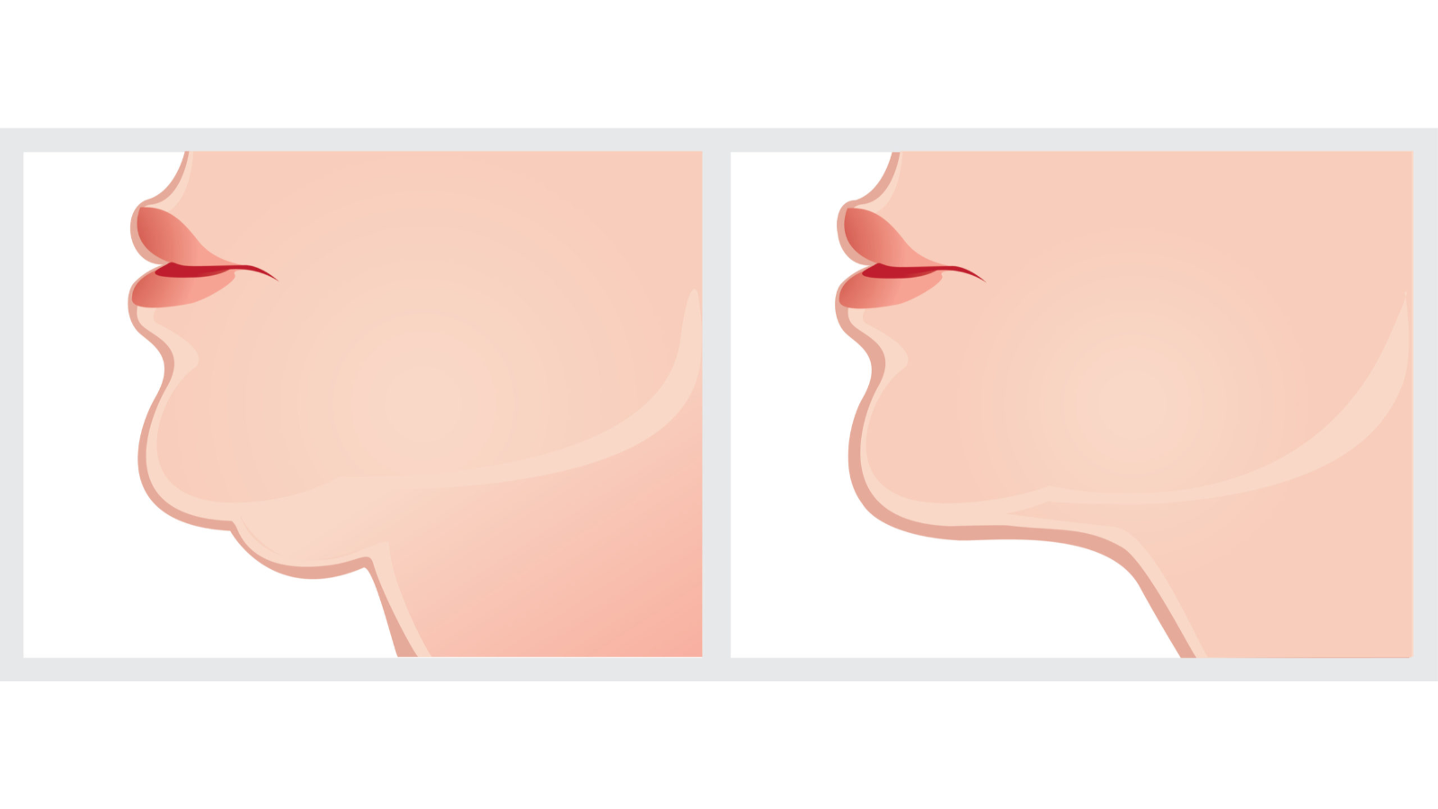 What to Know About Kybella