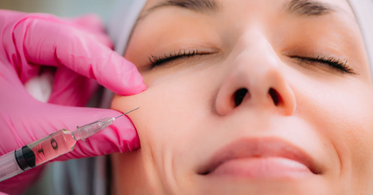 Radiesse dermal filler syringe for cheek volume restoration in Oak Brook, IL