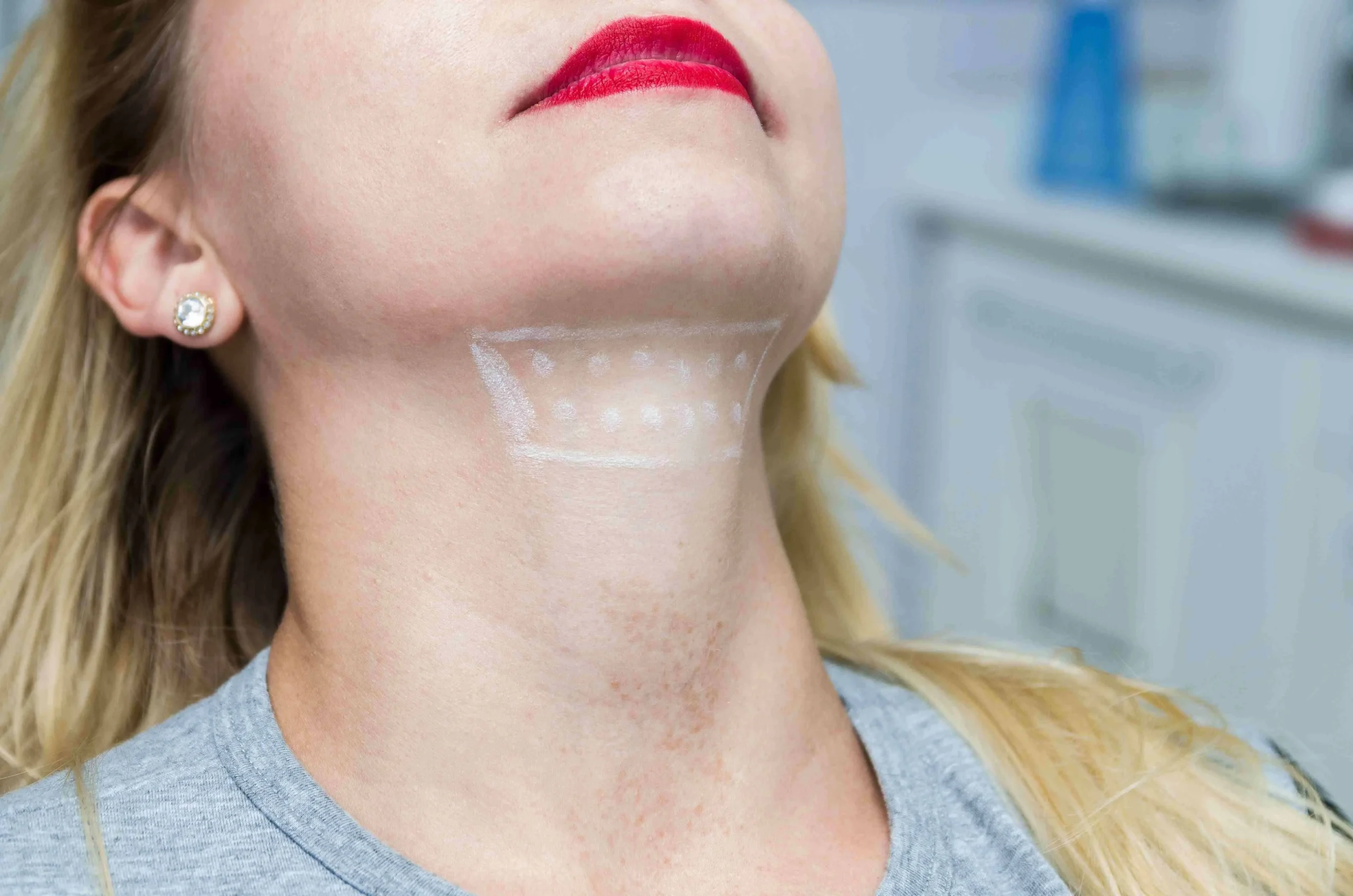 When to Expect Kybella Treatment Result at Arabella Boutique Med Spa